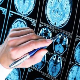 Scoperto meccanismo chiave dell'Alzheimer: speranza per diagnosi e cure